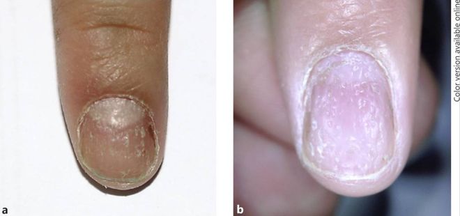 孩子指甲軟薄易斷、月牙少、長白點、豎紋是顯示身體有健康風(fēng)險嗎？(圖7)