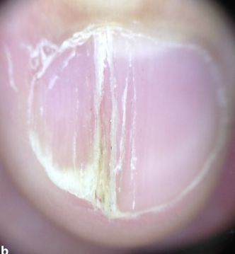 孩子指甲軟薄易斷、月牙少、長白點、豎紋是顯示身體有健康風(fēng)險嗎？(圖11)