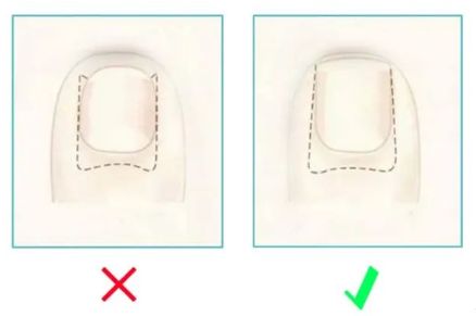 孩子指甲軟薄易斷、月牙少、長白點、豎紋是顯示身體有健康風(fēng)險嗎？(圖13)