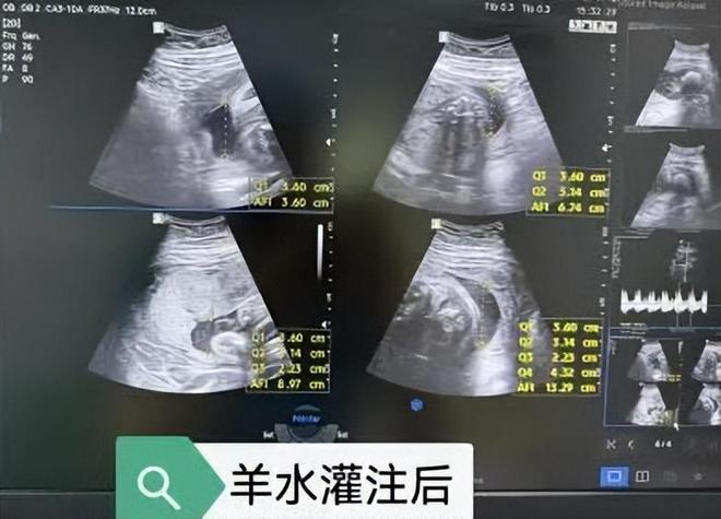 【邯鄲首例】邯鄲市第一醫(yī)院成功實施胎兒羊水灌注術(shù)(圖3)